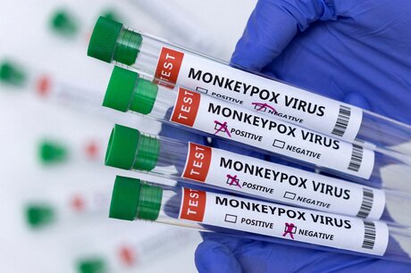 La variole du singe continue de progresser en France